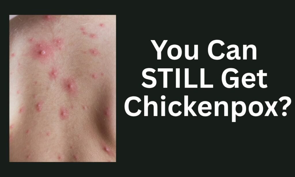 You Can STILL Get Chickenpox?! Here’s the Truth